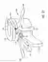 Fig. 30 - Disc annulus repair system