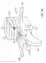 Fig. 32 - Disc annulus repair system