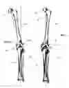 Fig. 02 - Method and apparatus for achieving correct limb alignment in unicondylar knee arthroplasty