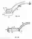 Fig. 02 - Corneal retention or stabilizing tool