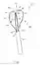 Fig. 02 - Laser resistant calculus retrieval device and method of using