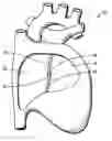 Fig. 01 - System and method for bonding closure of an intra-cardiac opening using energy
