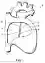Fig. 02 - System and method for bonding closure of an intra-cardiac opening using energy