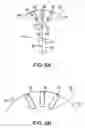 Fig. 06 - System and method for bonding closure of an intra-cardiac opening using energy