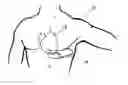 Fig. 01 - Subcutaneous cardioverter-defibrillator