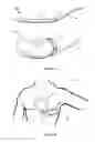 Fig. 02 - Subcutaneous cardioverter-defibrillator