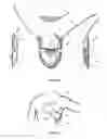 Fig. 03 - Subcutaneous cardioverter-defibrillator