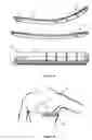 Fig. 04 - Subcutaneous cardioverter-defibrillator
