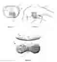 Fig. 11 - Subcutaneous cardioverter-defibrillator