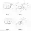 Fig. 14 - Subcutaneous cardioverter-defibrillator