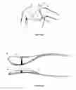 Fig. 18 - Subcutaneous cardioverter-defibrillator