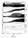 Fig. 16 - Multi-site PESP with fusion pacing