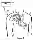 Fig. 02 - Atrial capture management in minimal ventricular pacing system and method