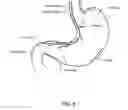 Fig. 07 - Weight loss method and device