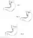 Fig. 08 - Weight loss method and device