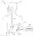 Fig. 01 - Intra-luminal device for gastrointestinal stimulation