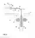 Fig. 05 - Implantable optical pressure sensor for sensing urinary sphincter pressure