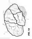 Fig. 02 - Methods and systems for treating autism by decreasing neural activity within the brain