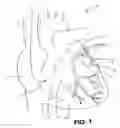 Fig. 02 - Guide catheters for accessing cardiac sites