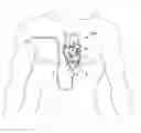 Fig. 01 - Cardiac electrode anchoring system
