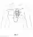 Fig. 02 - Cardiac electrode anchoring system