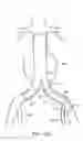 Fig. 16 - Branched vessel endoluminal device with fenestration