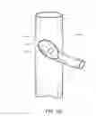 Fig. 23 - Branched vessel endoluminal device with fenestration