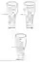 Fig. 27 - Branched vessel endoluminal device with fenestration