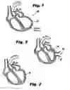 Fig. 02 - System and method for sizing a heart for treating congestive heart failure