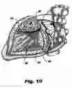 Fig. 07 - System and method for sizing a heart for treating congestive heart failure