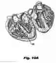 Fig. 08 - System and method for sizing a heart for treating congestive heart failure