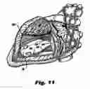 Fig. 09 - System and method for sizing a heart for treating congestive heart failure