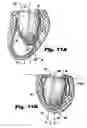 Fig. 10 - System and method for sizing a heart for treating congestive heart failure