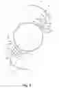 Fig. 03 - Accommodating intraocular lens implant