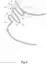 Fig. 04 - Accommodating intraocular lens implant