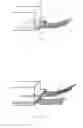 Fig. 12 - Systems and methods for augmenting intervertebral discs