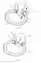 Fig. 43 - Systems and methods for augmenting intervertebral discs