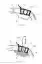 Fig. 47 - Systems and methods for augmenting intervertebral discs
