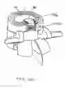 Fig. 85 - Systems and methods for augmenting intervertebral discs