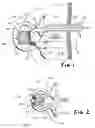Fig. 02 - Spinal fusion with osteogenic material and migration barrier