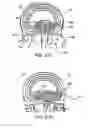 Fig. 33 - Devices, systems and methods for augmenting intervertebral discs