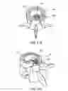 Fig. 34 - Devices, systems and methods for augmenting intervertebral discs