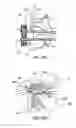 Fig. 40 - Devices, systems and methods for augmenting intervertebral discs