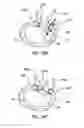 Fig. 43 - Devices, systems and methods for augmenting intervertebral discs