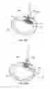 Fig. 45 - Devices, systems and methods for augmenting intervertebral discs