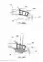 Fig. 47 - Devices, systems and methods for augmenting intervertebral discs