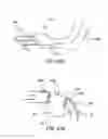 Fig. 49 - Devices, systems and methods for augmenting intervertebral discs