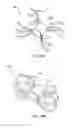 Fig. 80 - Devices, systems and methods for augmenting intervertebral discs