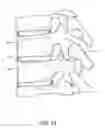 Fig. 13 - Method for delivering and positioning implants in the intervertebral disc environment
