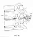 Fig. 14 - Method for delivering and positioning implants in the intervertebral disc environment